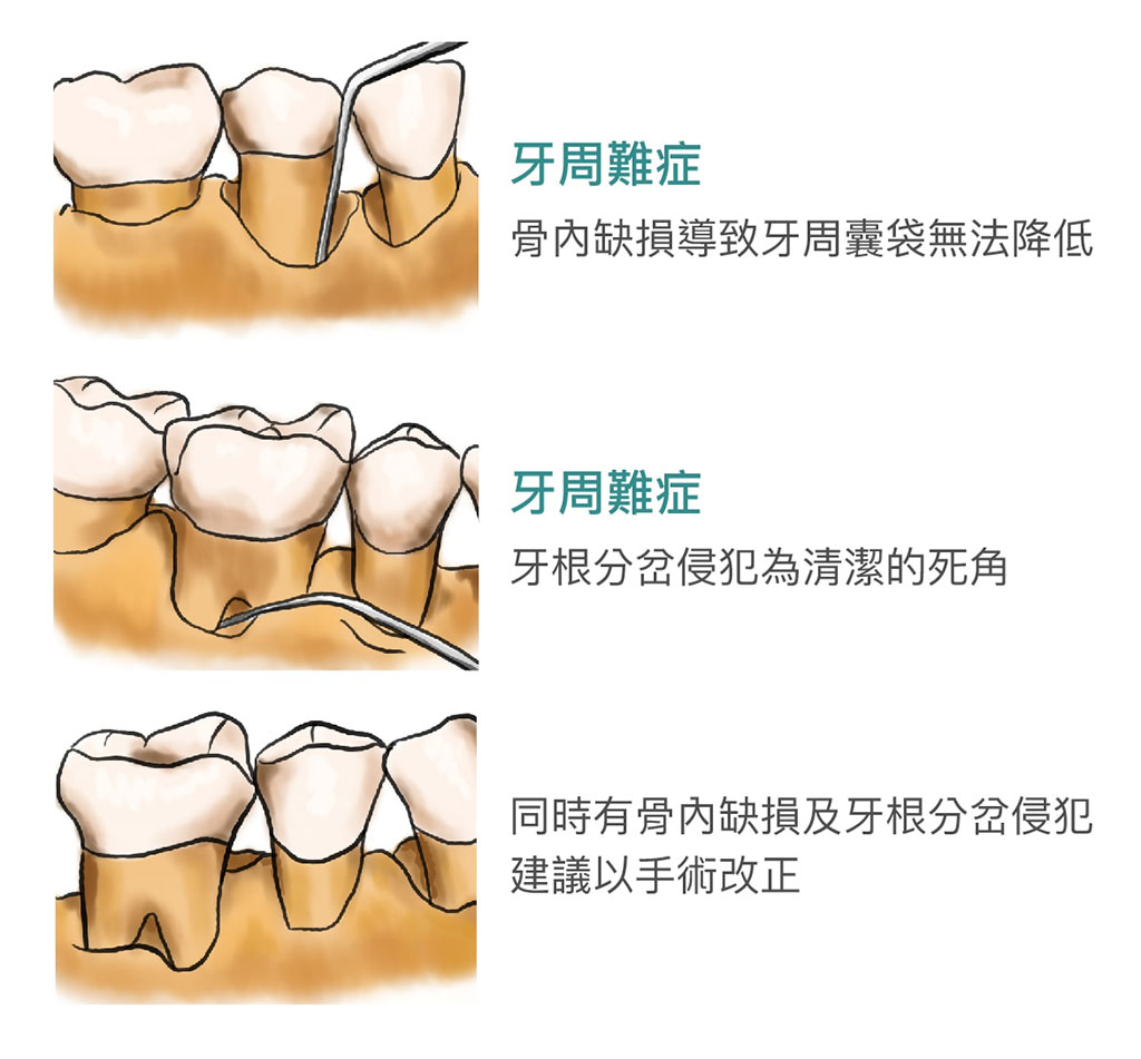 牙周病手術 葉立維醫師 牙周專科 植牙專科醫師 桃園牙周病推薦首選