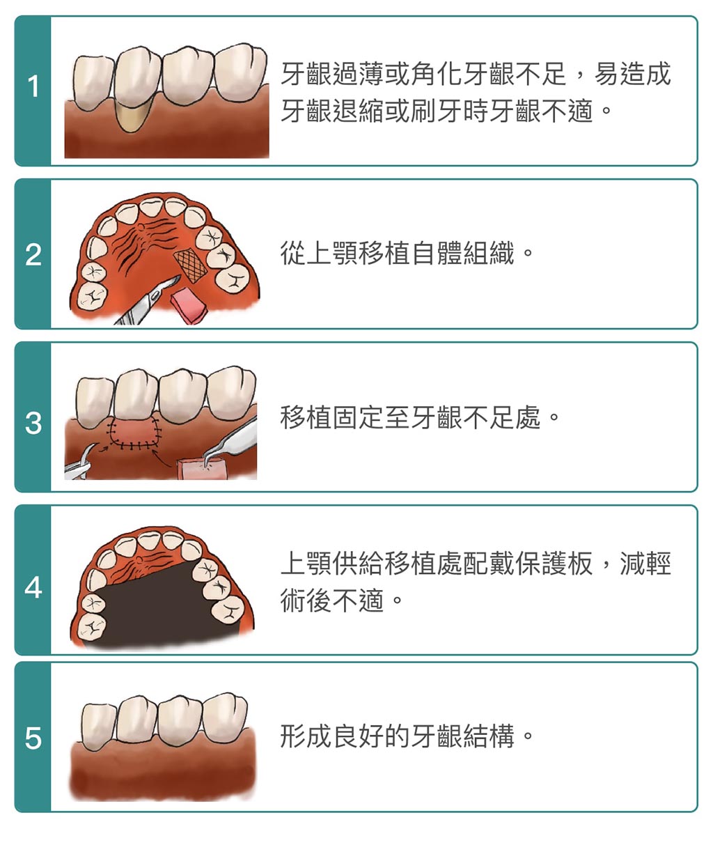 牙周整形手術 葉立維醫師 牙周專科 植牙專科 桃園牙周病推薦首選