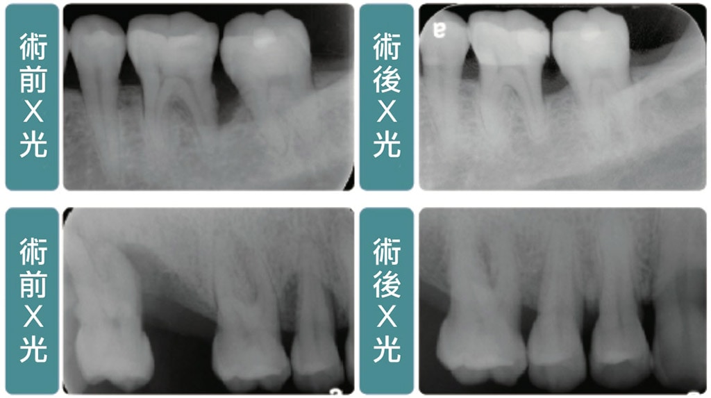 牙周病手術 葉立維醫師 牙周專科 植牙專科醫師 桃園牙周病推薦首選