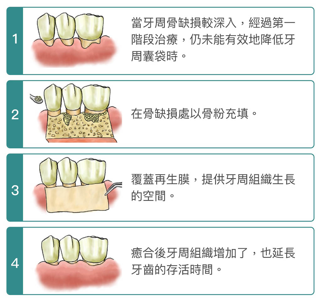 牙周病手術 葉立維醫師 牙周專科 植牙專科醫師 桃園牙周病推薦首選