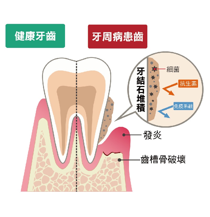 牙周病治療經驗 什麼情況需要做牙周翻瓣手術 嚴重牙周病推薦必看