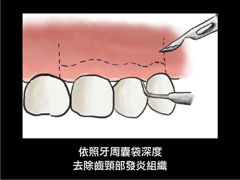 牙周病治療經驗 什麼情況需要做牙周翻瓣手術 嚴重牙周病推薦必看