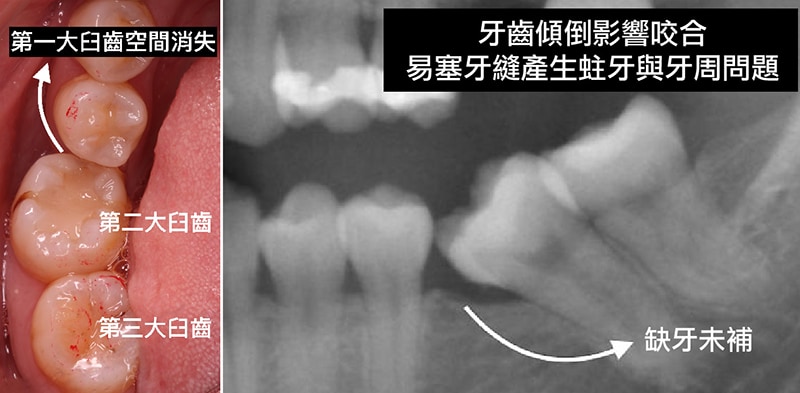 中度牙周病治療推薦 全口牙周病 牙冠增長術 鼻竇增高術 桃園葉立維醫師