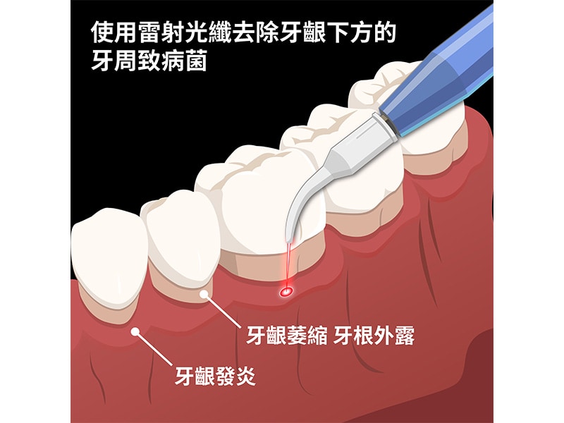 雷射治療牙周病的效果好嗎 雷射 跟 水雷射 牙周病治療費用及優缺點比較 葉立維醫師