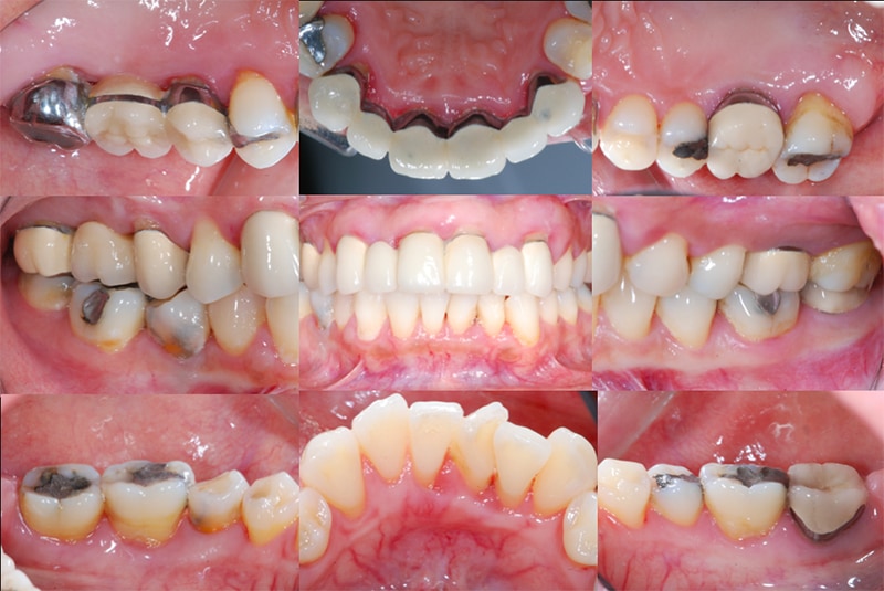 嚴重牙周病治療推薦 全口牙周病 牙周翻瓣手術 牙周再生手術 葉立維醫師