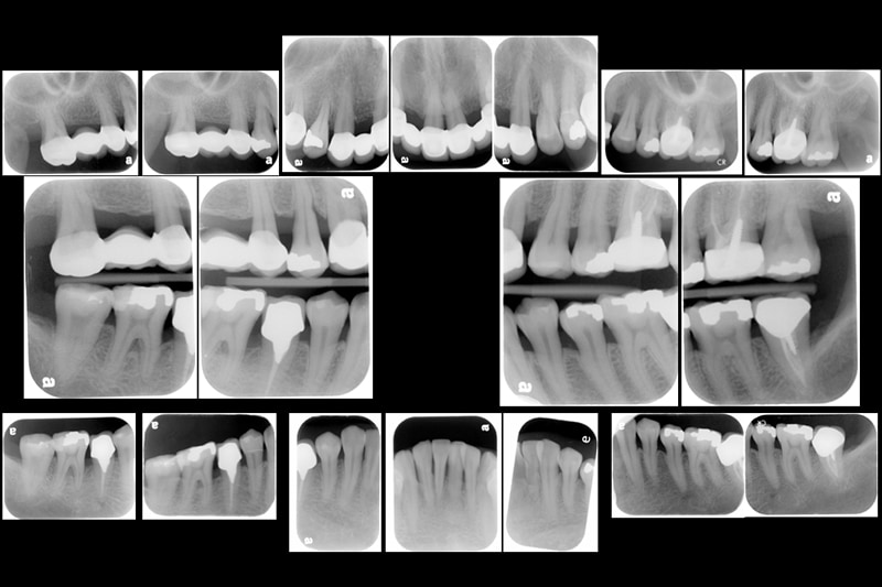 嚴重牙周病治療推薦 全口牙周病 牙周翻瓣手術 牙周再生手術 葉立維醫師