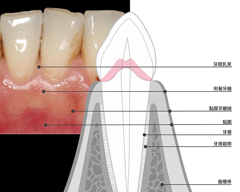 牙齦萎縮如何補救 牙周專科醫師詳解牙齦萎縮原因 症狀與治療方法