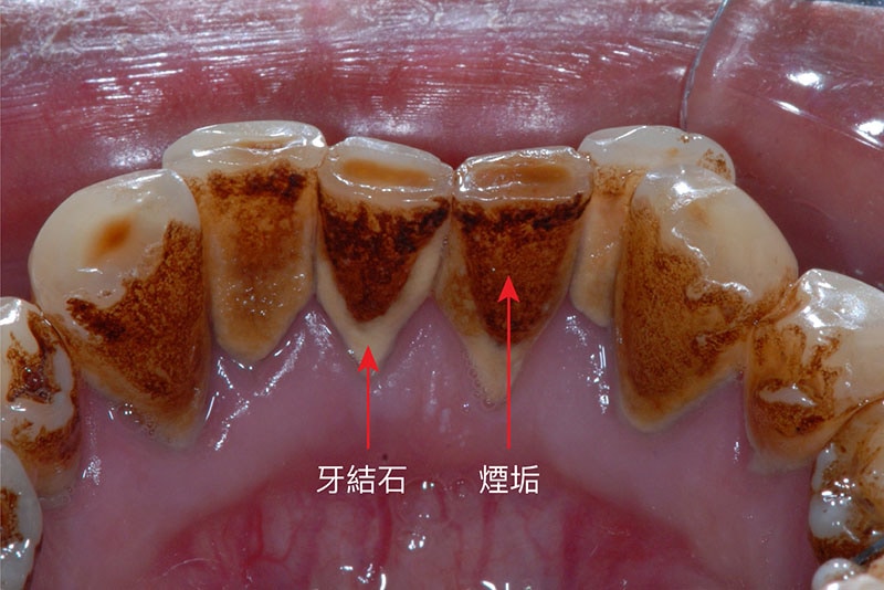 牙周病治療費用-牙結石-煙垢-比較-葉立維醫師-桃園牙周病