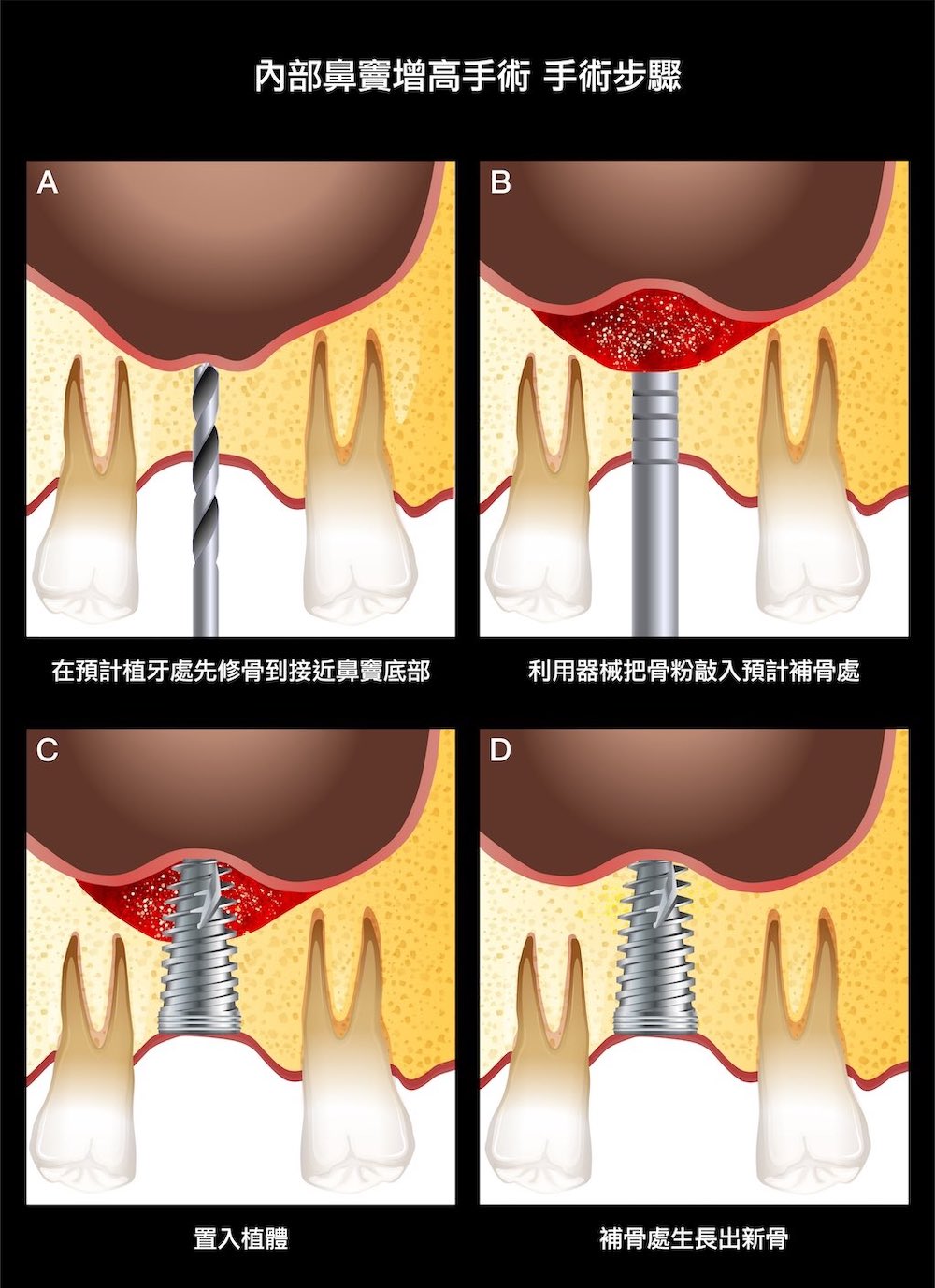 鼻竇增高術-內部鼻竇增高術-手術步驟-上顎植牙-植牙補骨-葉立維醫師-桃園