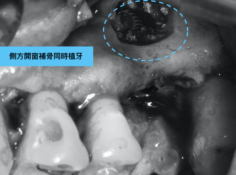 鼻竇增高術-外部鼻竇增高術-植牙補骨-左上第一大臼齒-上顎植牙-成功率-葉立維醫師-桃園