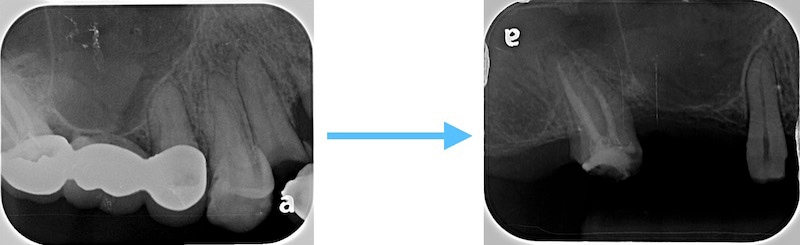 右上假牙拆除前後的局部X光片紀錄