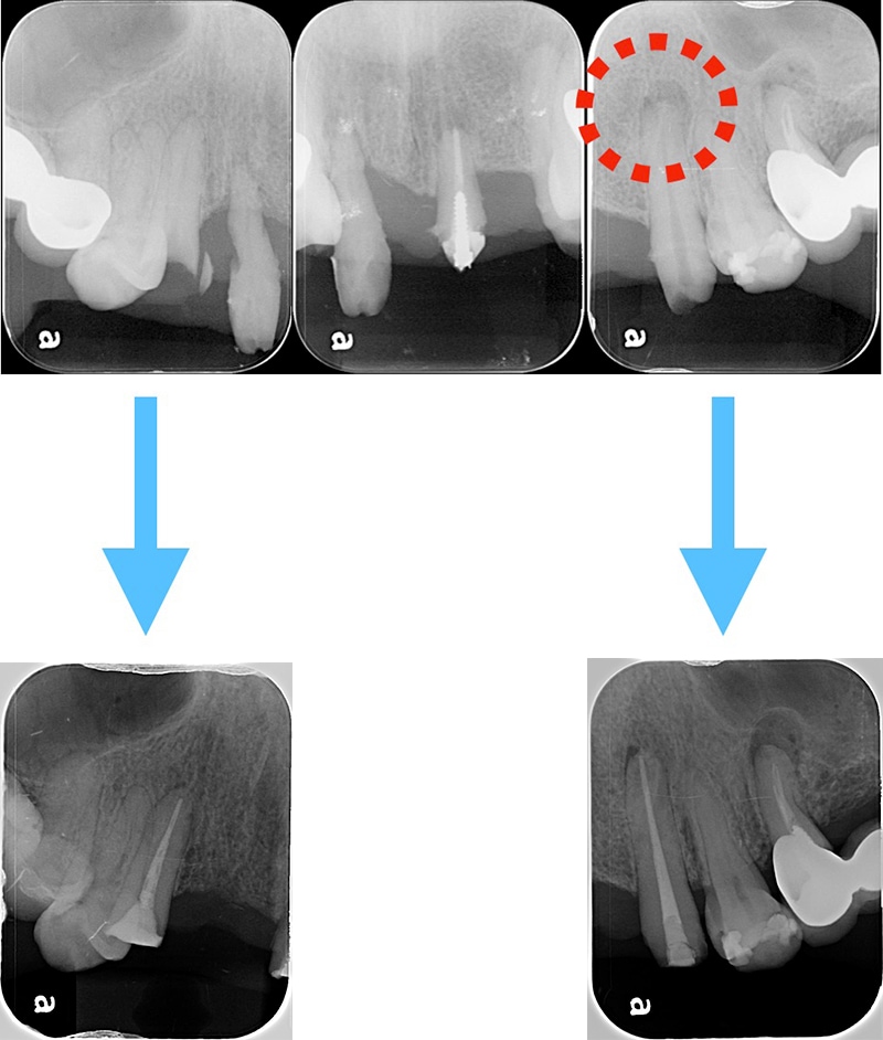 右上和左上犬齒根管治療前後局部X光片
