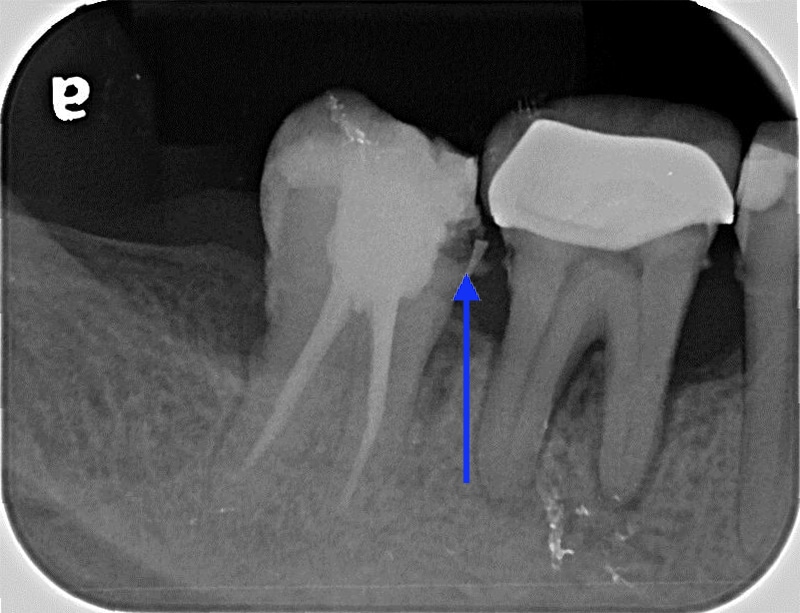 右下第二大臼齒局部X光，做過根管治療未完成修復，懷疑在鄰接面有二次蛀牙