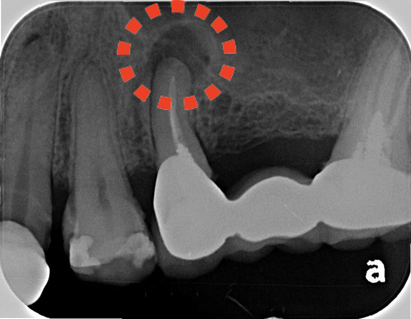 左上第二小臼齒局部X光片呈現根尖周圍有骨頭破壞