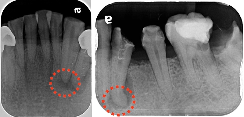左下犬齒和第一小臼齒局部X光片，呈現牙根尖周圍有骨頭破壞與牙根彎曲