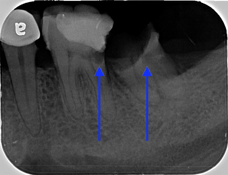 左下第一大臼齒與第二大臼齒局部X光片，第一大臼齒在牙根處懷疑有蛀牙的情況；第二大臼齒結構不足無法修復