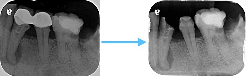 左下第一、第二小臼齒的假牙拆除前後局部X光片紀錄