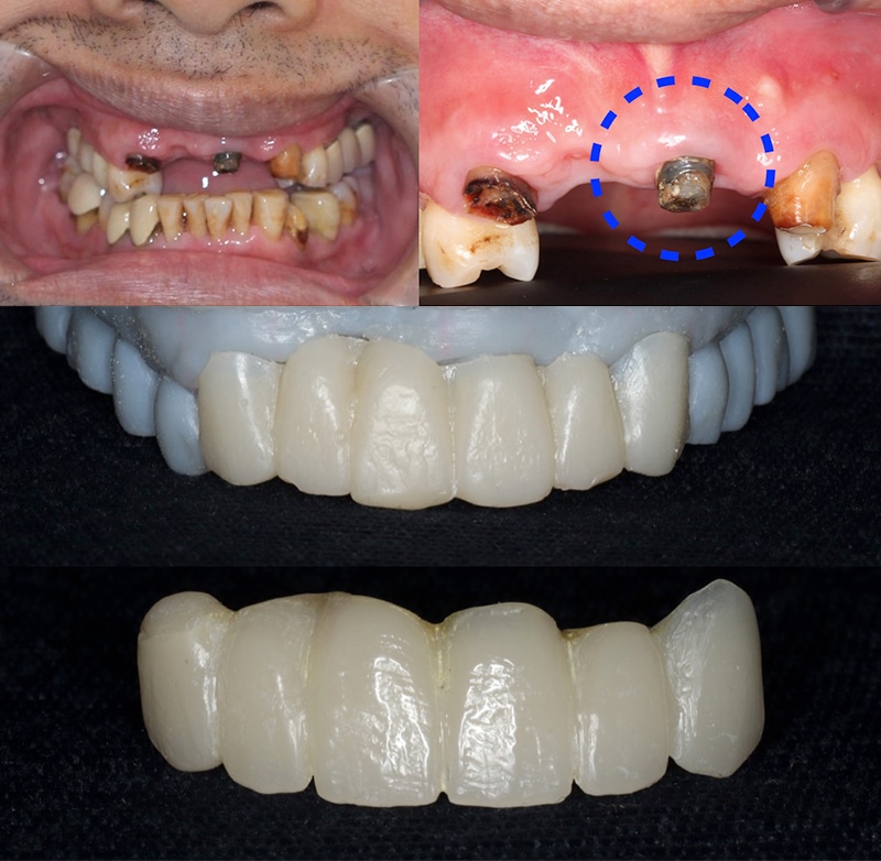 拆除不密合舊假牙前後口內照，暫時保留門牙，採數位微笑設計原理和口內掃描製作臨時假牙