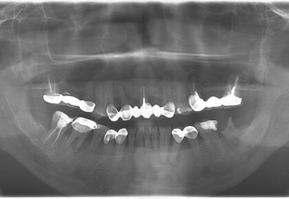 中度牙周病治療推薦: 蛀牙/假牙不密合/根管治療/植牙/全口重建