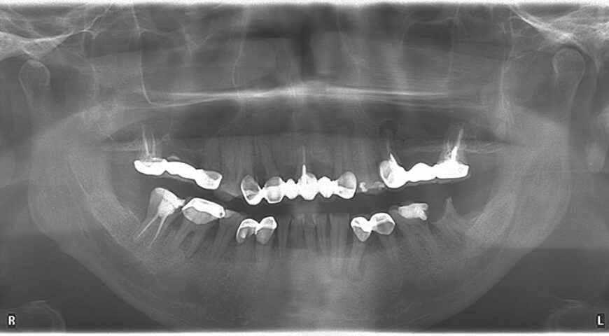 中度牙周病治療推薦: 蛀牙/假牙不密合/根管治療/植牙/全口重建