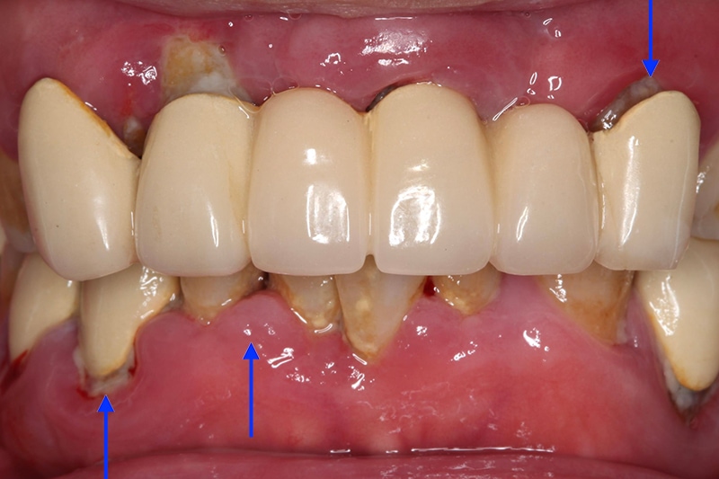 牙周病治療前的口內照，假牙不密合而露出黑邊，且牙齦紅腫、化膿，有多處牙菌斑