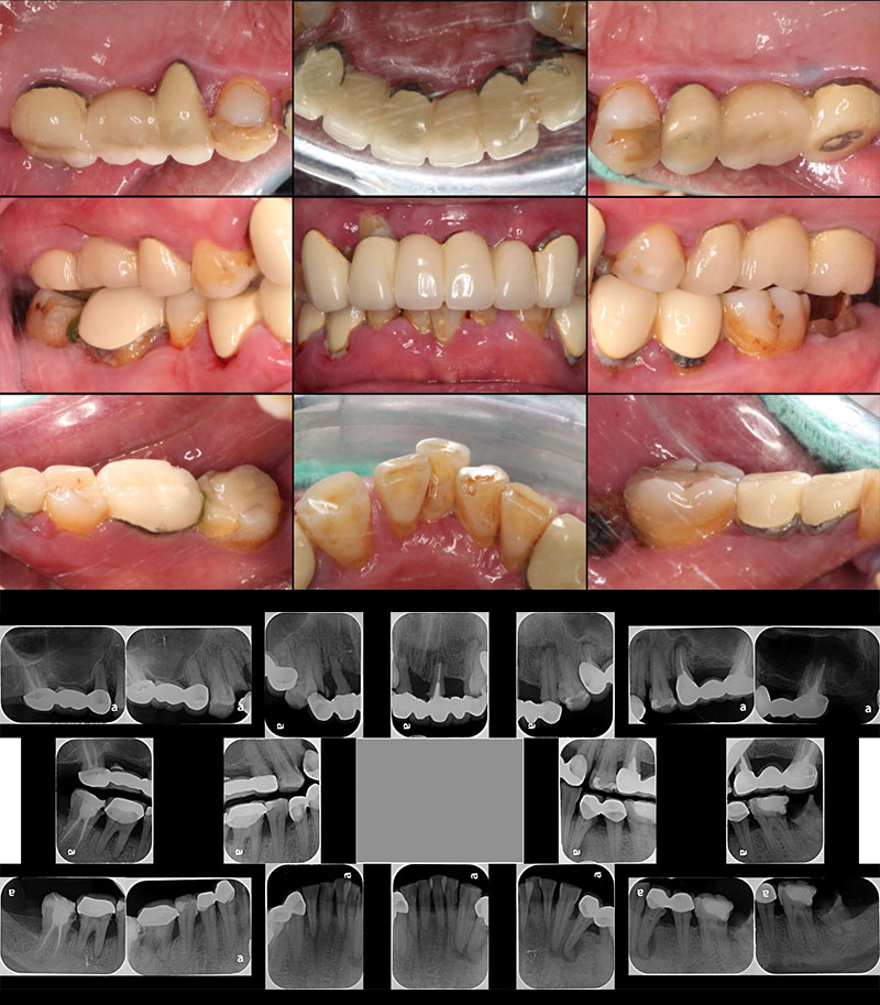 牙周專科醫師進行牙周病治療前，拍攝的口內照和局部X光片