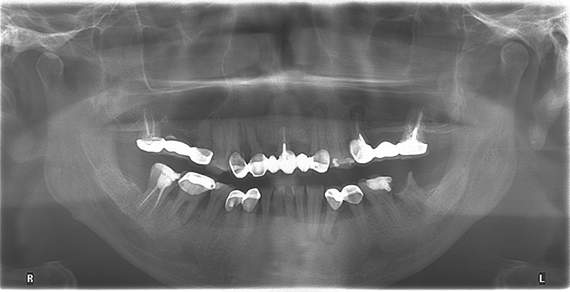 牙周病治療前的環口式X光片，口內有很多蛀牙、舊假牙，牙周破壞造成齒槽骨流失