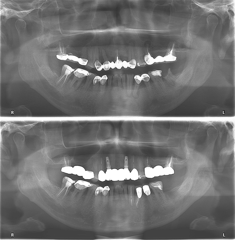蛀牙、牙周病治療、根管治療和植牙全口重建前後環口X光片對比，保留大部分牙齒