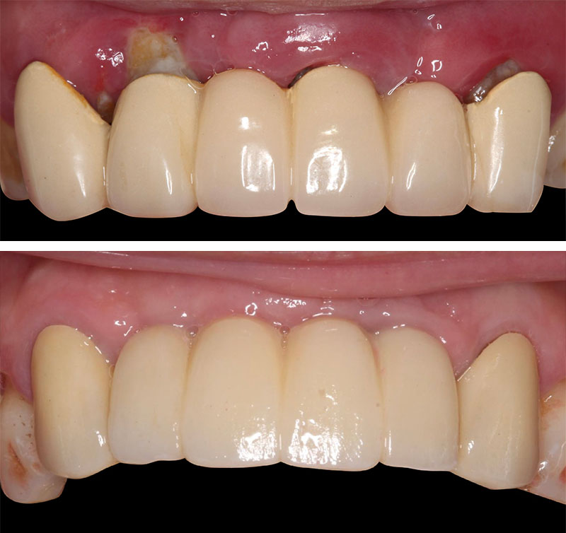 牙周治療、植牙前後對比：術前舊假牙不密合且牙齦紅腫發炎；術後全瓷冠修復改善美觀，牙齦也恢復健康狀態