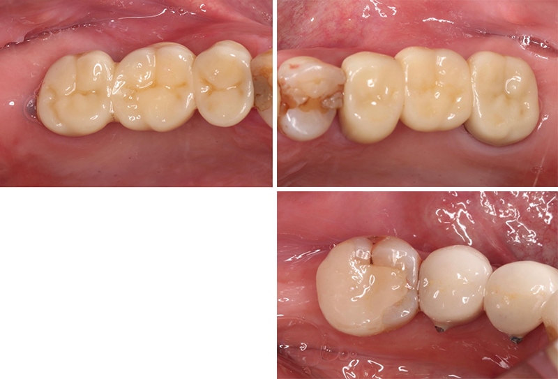 後牙修復後口內照：右上及左上後牙區以氧化鋯牙橋修復；左下兩顆小臼齒用金屬燒附陶瓷牙冠修復，第一大臼齒以全瓷3D齒雕修復