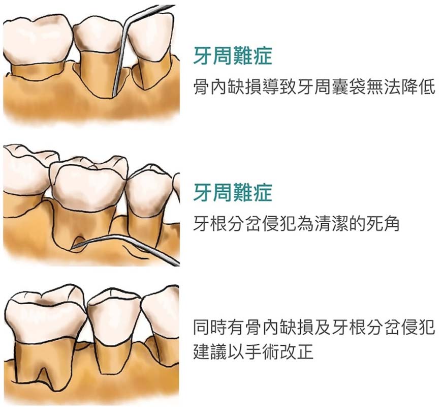 建議進行牙周手術的情況