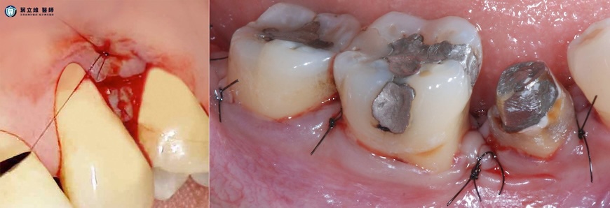 顯微微創手術傷口比傳統牙周手術小